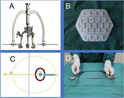 Experience of Using a New Brain Surgery Head Frame and Location Sticker for Treating Spontaneous Intracranial Hematoma